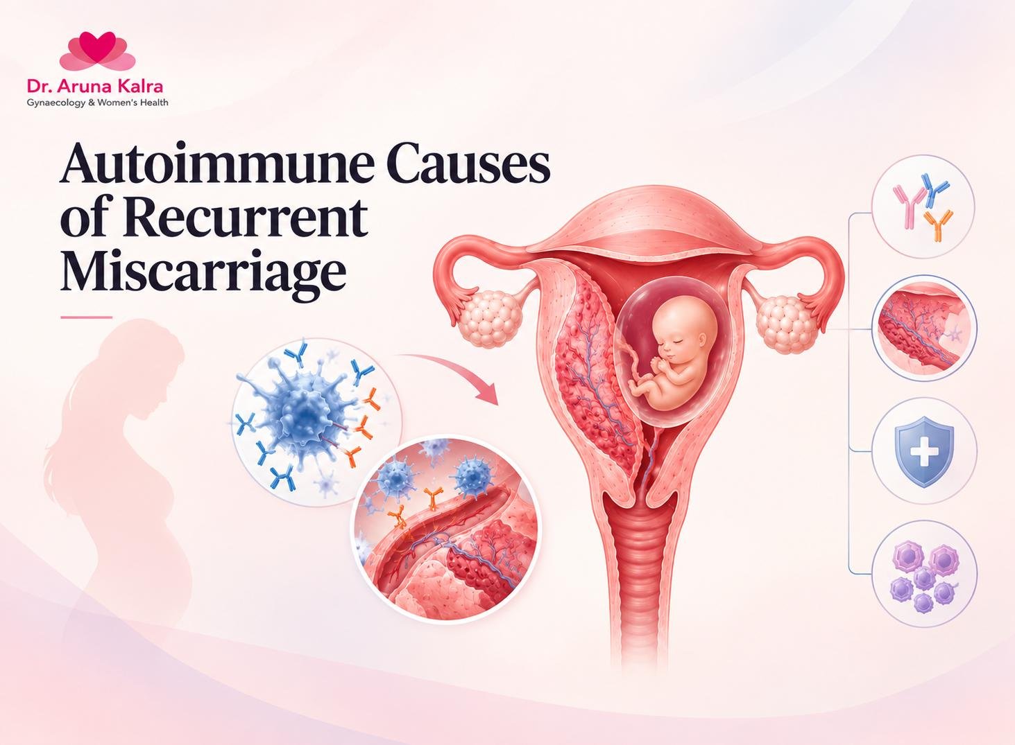 Learn about the autoimmune causes of recurrent pregnancy loss