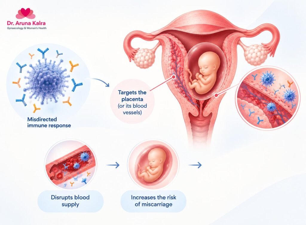 Autoimmune Disease and Recurrent Miscarriage