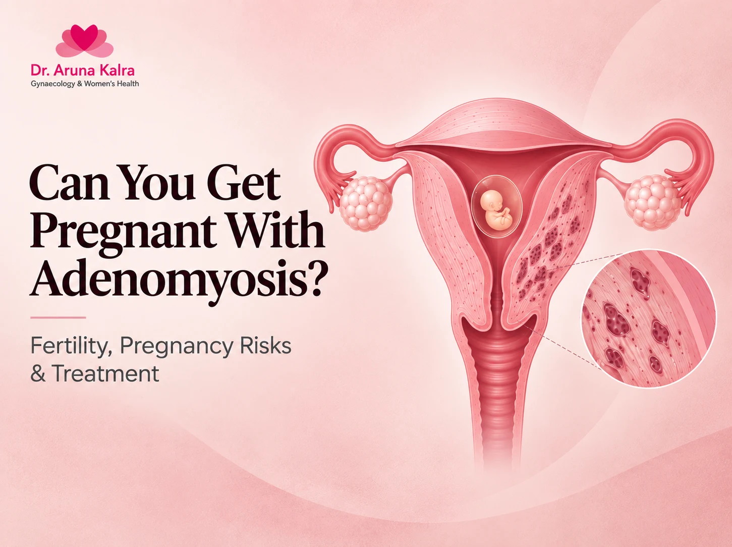 Can you get pregnant with adenomyosis? Medical illustration showing an adenomyosis-affected uterus with an embryo, highlighting fertility, pregnancy risks and treatment.